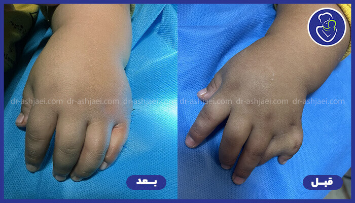جراحی چند انگشتی در کودکان و نوزادان