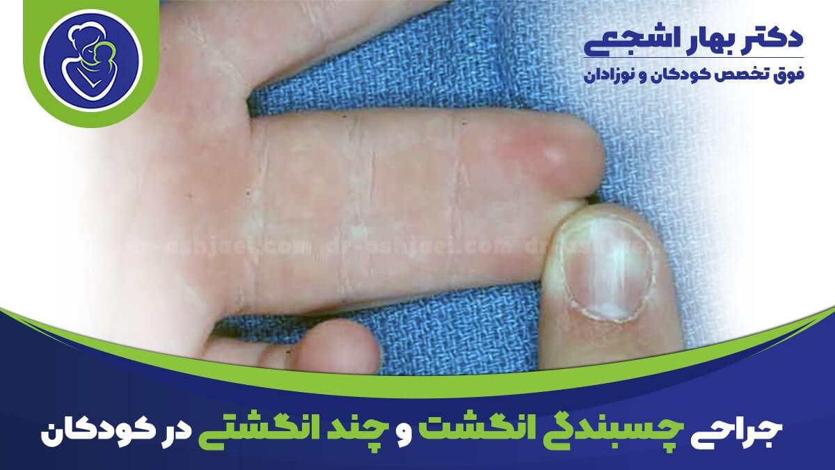عکس جراحی چسبندگی انگشت و چند انگشتی در کودکان