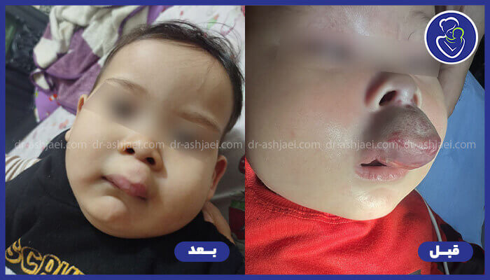 عکس همانژیوم در نوزادان