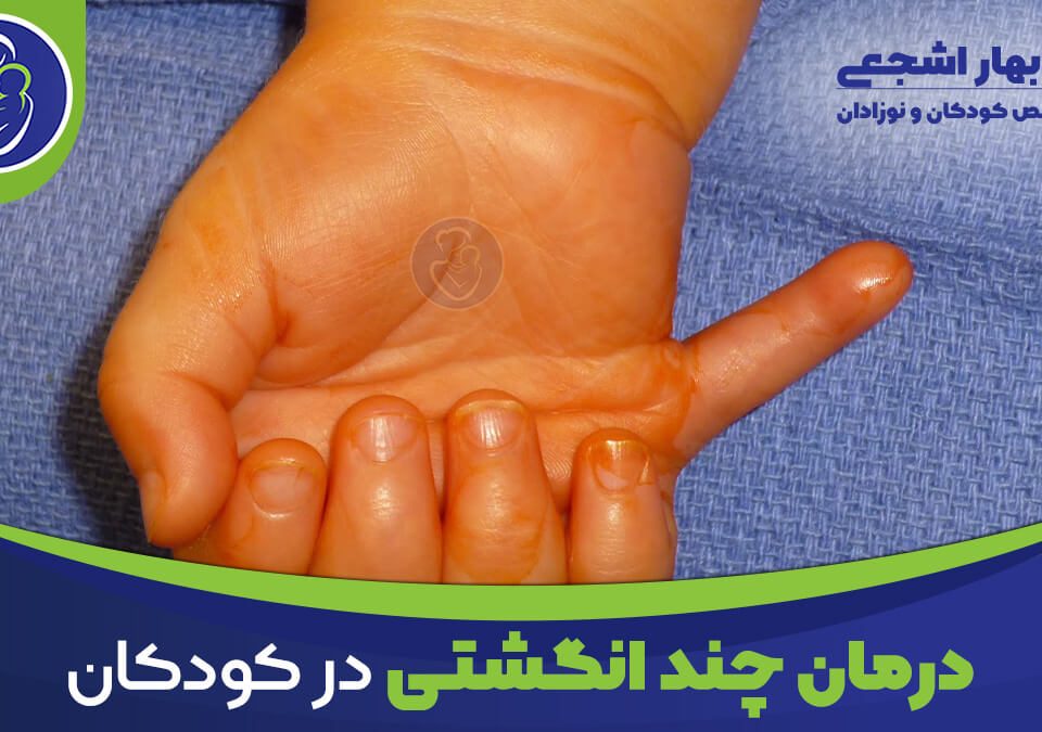 عکس انگشت اضافه یا چند انگشتی در کودکان