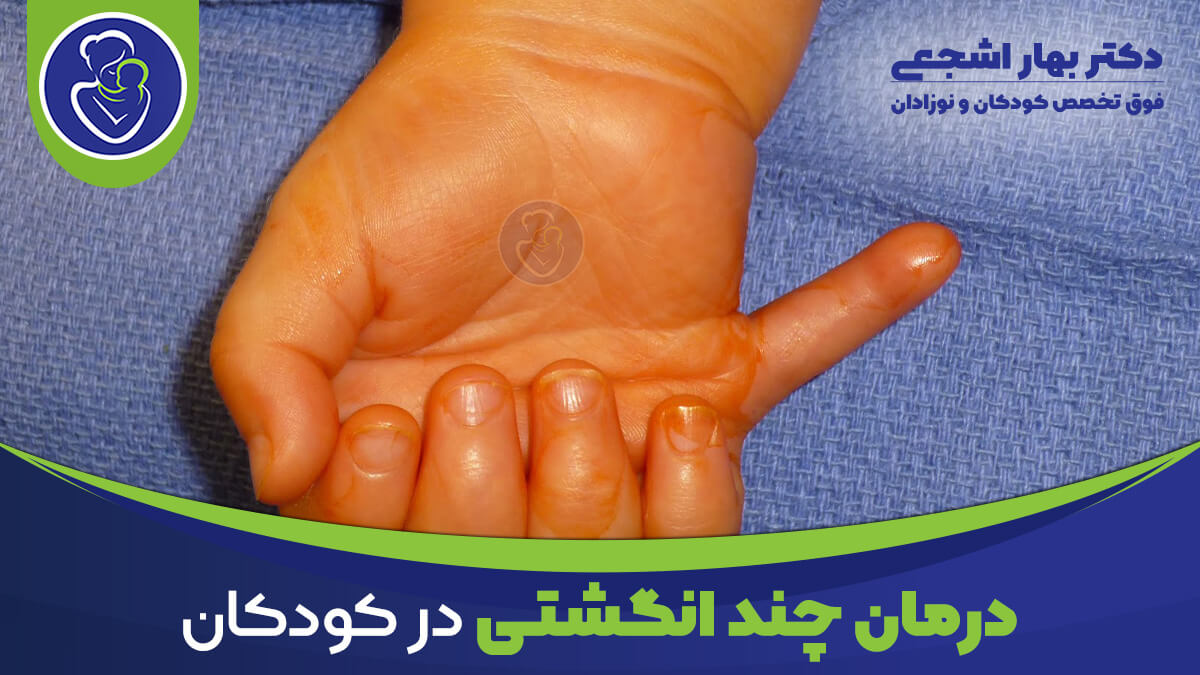 عکس انگشت اضافه یا چند انگشتی در کودکان