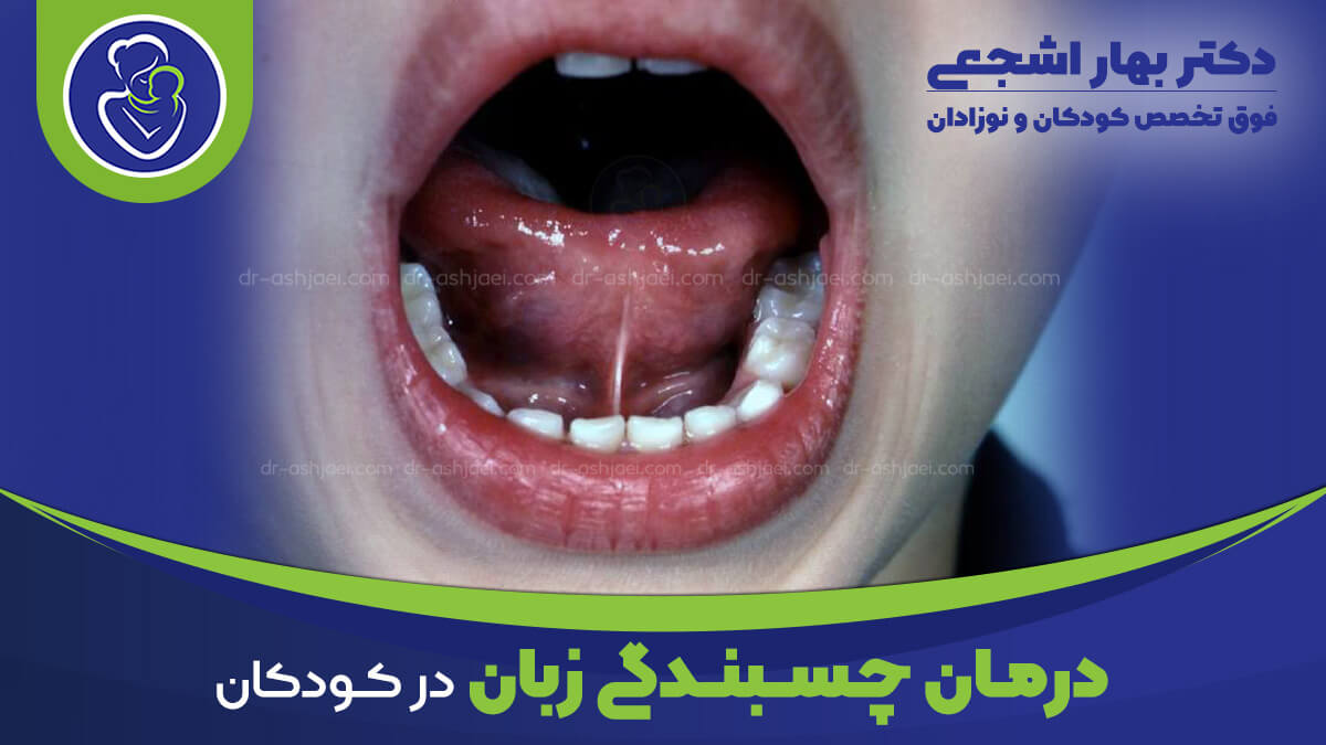 درمان چسبندگی زبان در کودکان و نوزادان
