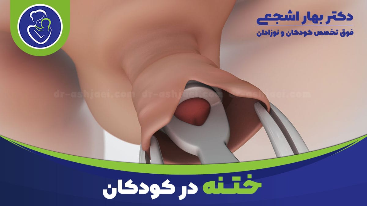 فوق تخصص جراحی کودکان ختنه