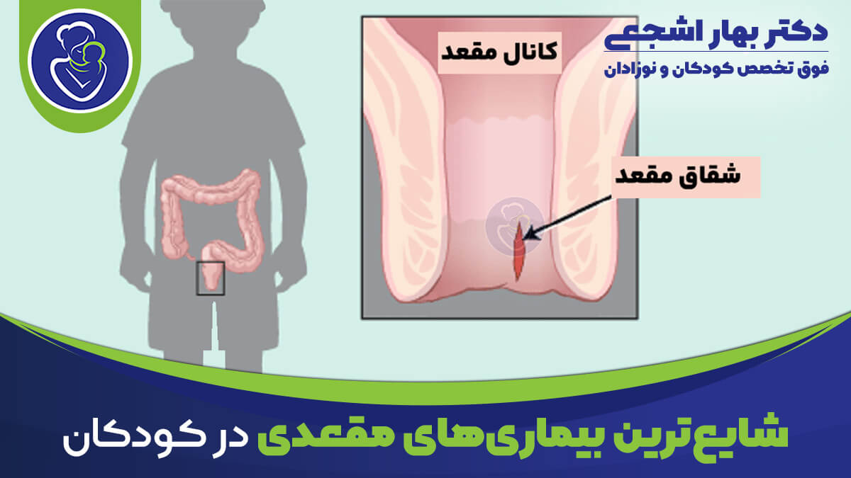 شایع ترین بیماری های مقعدی در کودکان