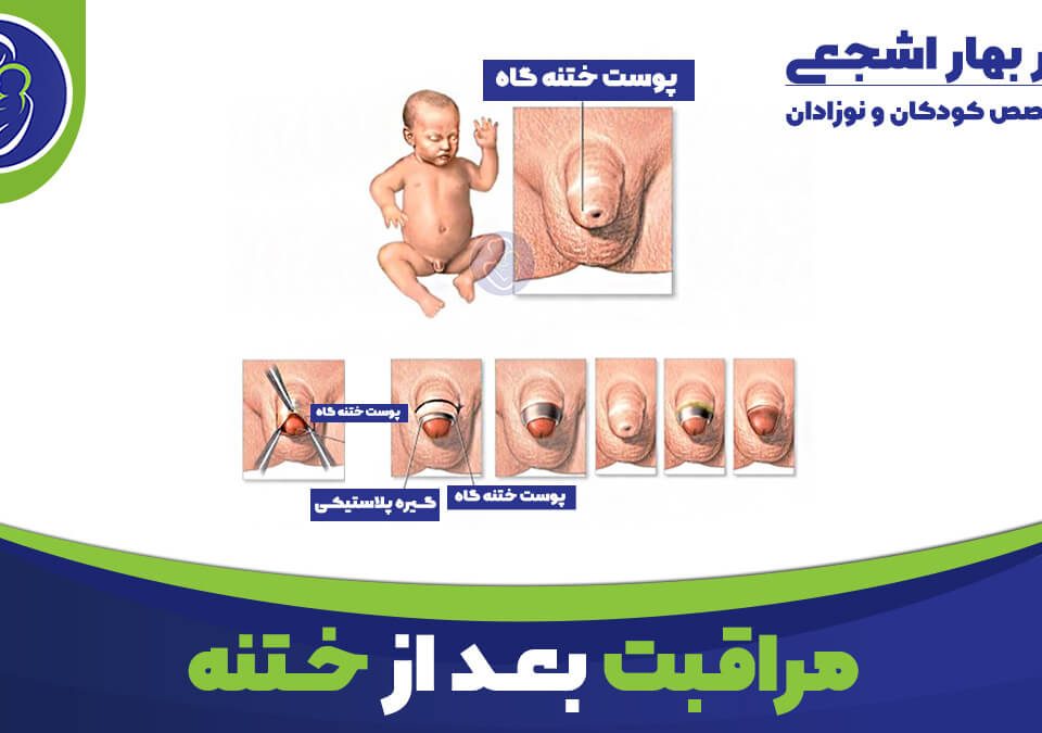 مراقبت های بعد از ختنه