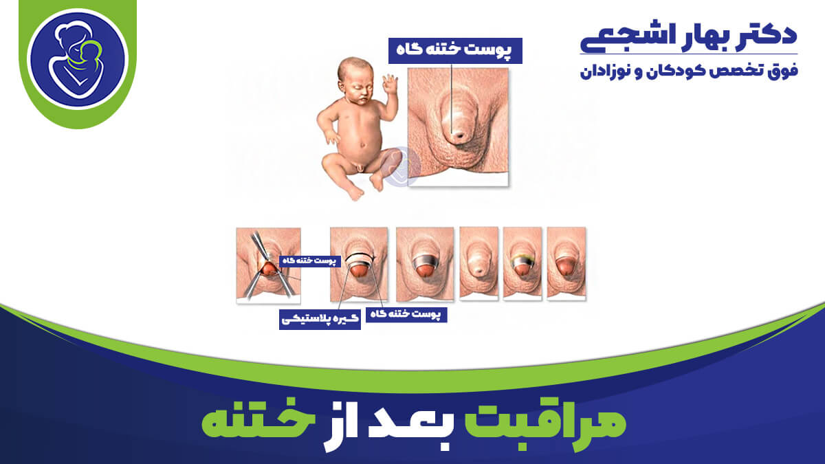 مراقبت های بعد از ختنه