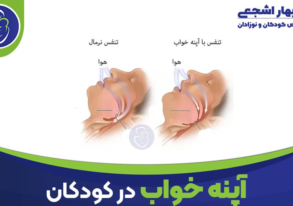 آپنه خواب انسدادی در کودکان