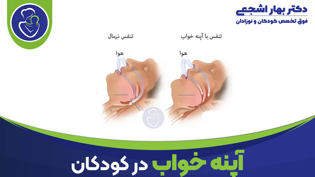 آپنه خواب انسدادی در کودکان