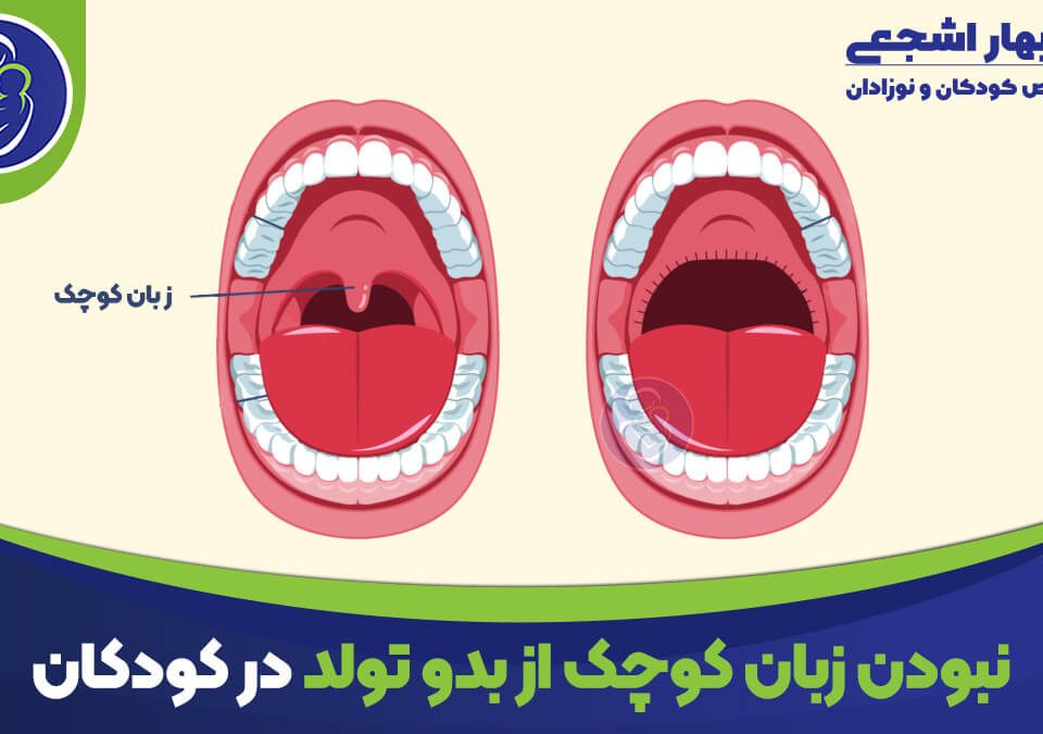 نبودن زبان کوچک از بدو تولد در کودکان